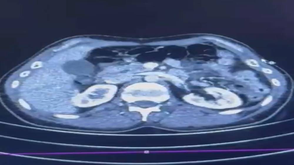 &Uuml;lkeye midelerinde uyuşturucu getiren şahıslar yakalandı
