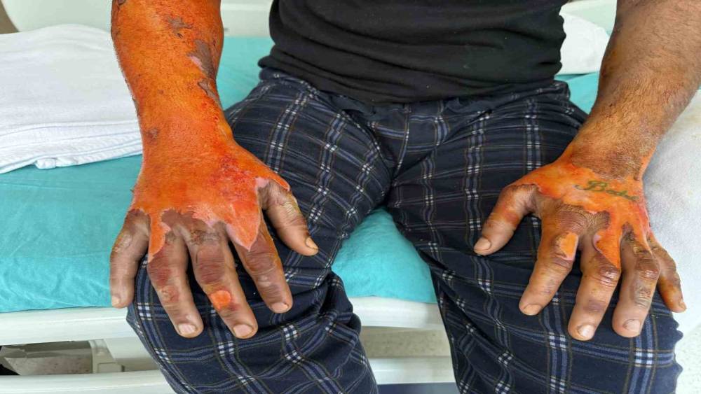 Ak&uuml; patlaması, v&uuml;cudunun y&uuml;zde 25&rsquo;i yandı: "Bomba gibi patlamalar, kendimi zor kurtardım"
