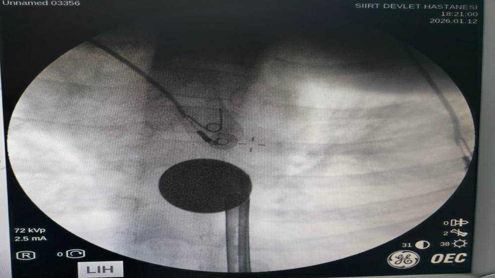 Siirt&rsquo;te boğazına madeni para ka&ccedil;an &ccedil;ocuk, doktorların m&uuml;dahalesi ile kurtarıldı
