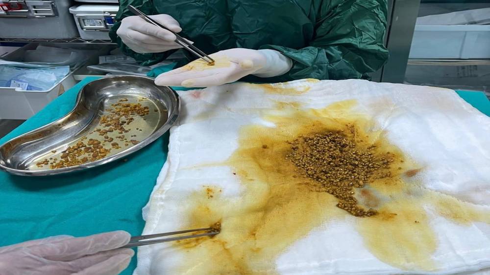 Bing&ouml;l&rsquo;de nadir vaka: Safra kesesinden 2 bin 67 taş &ccedil;ıkarıldı
