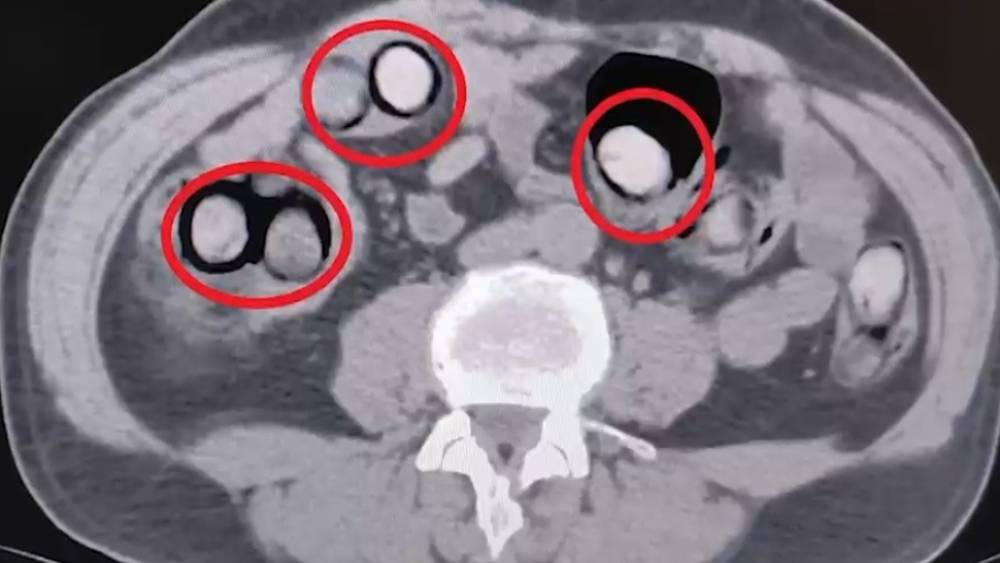 Mide ve bağırsaklarından 758 gram uyuşturucu &ccedil;ıktı
