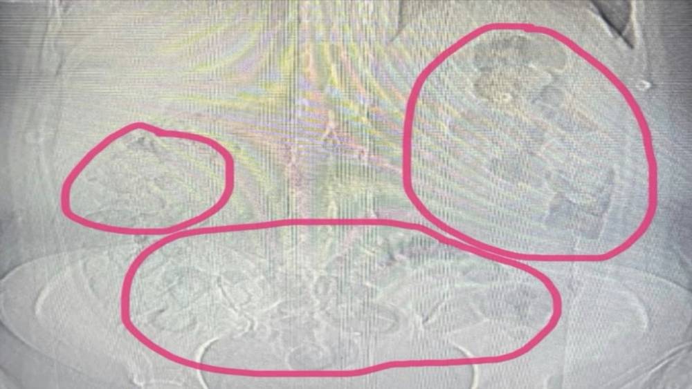 Midesinden uyuşturucu &ccedil;ıkan şahıs tutuklandı
